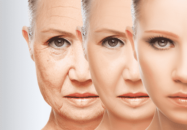 A woman's before and after Botox procedure images. 