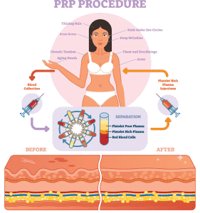 PRP vampire facelift infographic