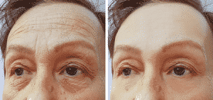 Before and after pictures of a Botox procedure.