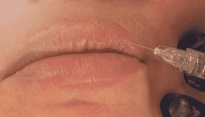 A patient's lips being injected with filler.